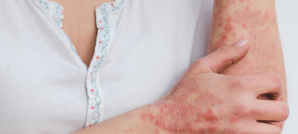 10 consigli per trattare la pelle con psoriasi