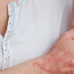 10 consigli per trattare la pelle con psoriasi